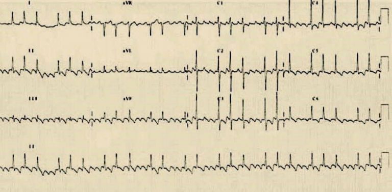 atypical atrial flutter icd 10