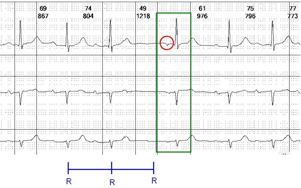 Existe escape atrial? - ECGNOW