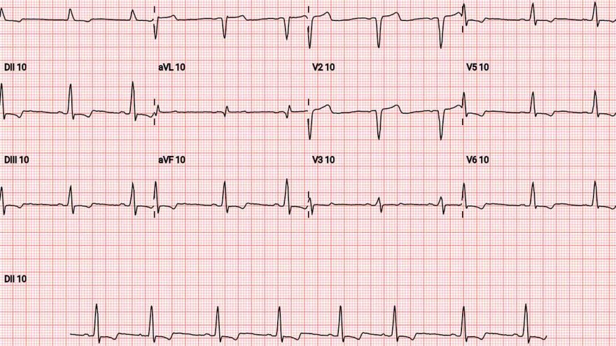 Disturbio-de-conducao-pelo-ramo-esquerdo-ou-Bloqueio-de-ramo-esquerdo-01