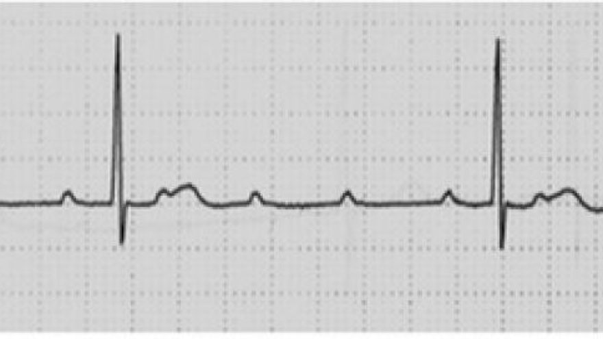 bloqueio-atrioventricular-avancado
