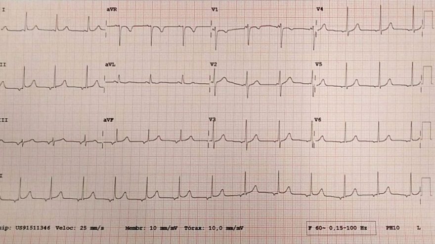 tem-P-mas-sera-que-e-sinusal