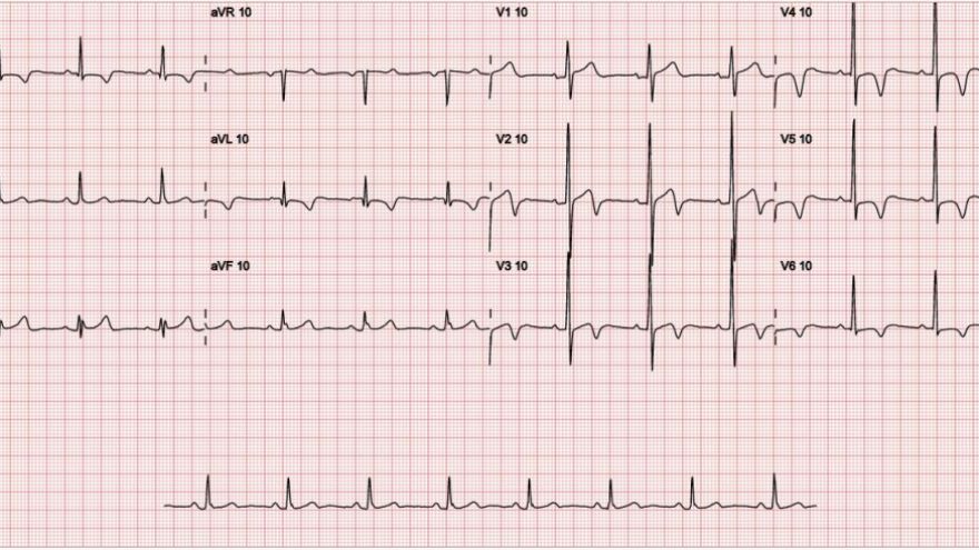 voce-sabe-o-que-e-a-sindrome-de-wellens